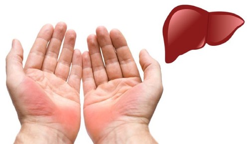 Bàn tay có dấu hiệu mắc bệnh về gan